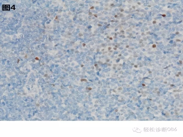 小B细胞非霍奇金淋巴瘤——慢性淋巴细胞白血病(2)