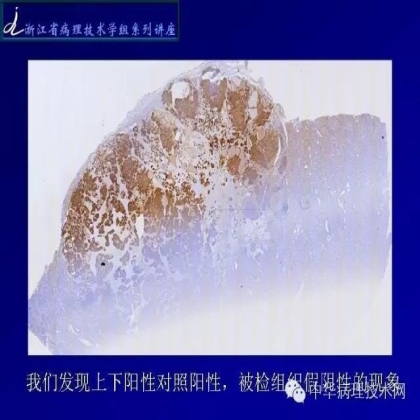 《常规免疫组化初筛ALK阳性非小细胞肺癌专家共识》技术部分解读