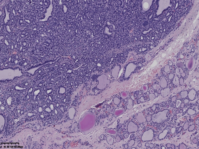 这个甲状腺肿瘤怎么看？