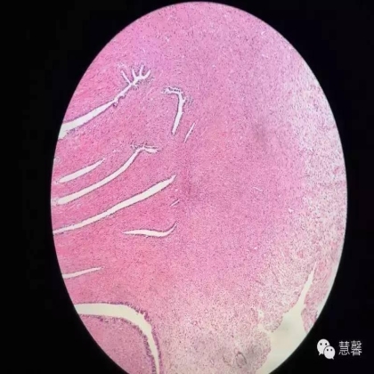 子宫腺肉瘤【吴梅娟】分享；【刘从容】老师讲解）