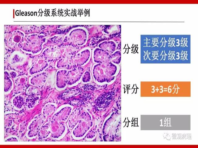 前列腺癌Gleason分级系统的前世今生