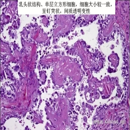 卵巢癌的病理诊断新进展（三）