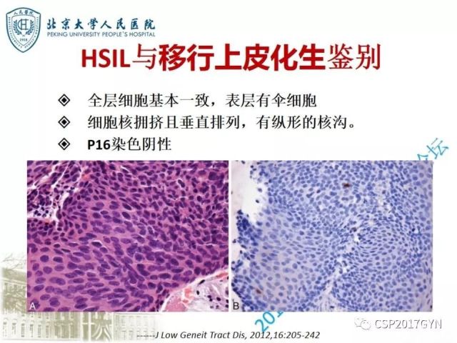 宫颈鳞状上皮内病变病理诊断中问题