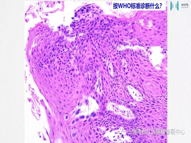 上消化道早癌病理诊断中的困惑及基本对策回顾