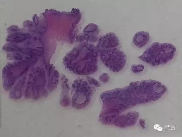 阴道鳞状上皮乳头状瘤？尖锐湿疣？（孔祥田老师病例分享，粉蓝医疗科技（杭州）有限公司女性生殖2群讨论，孔祥田(Max)*Roswell*老师讲解）