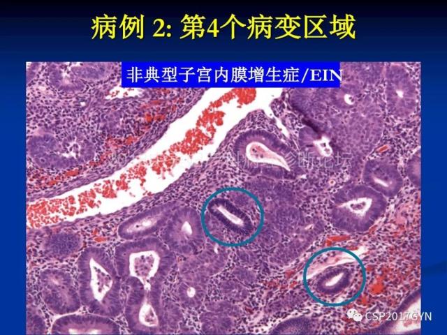 子宫内膜癌：诊断与进展