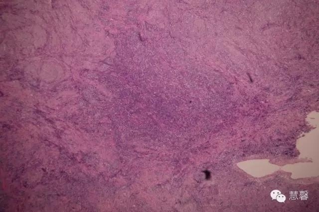 低分化支持－间质细胞瘤（ 戴敏病例分享，群友讨论，刘从容老师讲解）