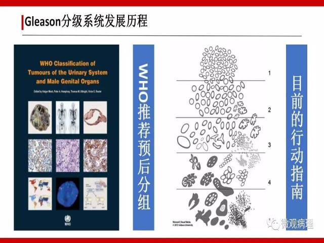 前列腺癌Gleason分级系统的前世今生