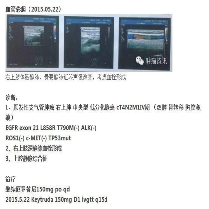 中日韩个体化诊疗案例大赛经典赏析之十四——27岁晚期NSCLC，精准治疗 与 指南盲区向左向右