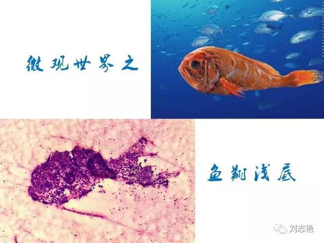 另类甲状腺FNA细胞学