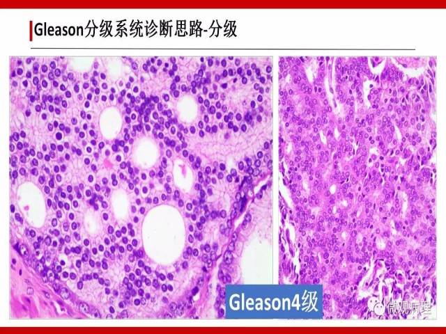 前列腺癌Gleason分级系统的前世今生