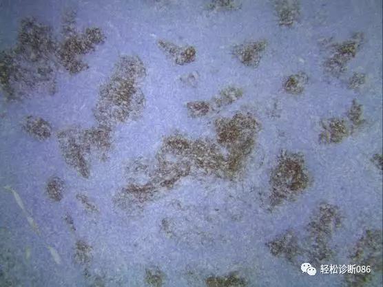 滤泡辅助T细胞（TFH）及其相关淋巴瘤（11）