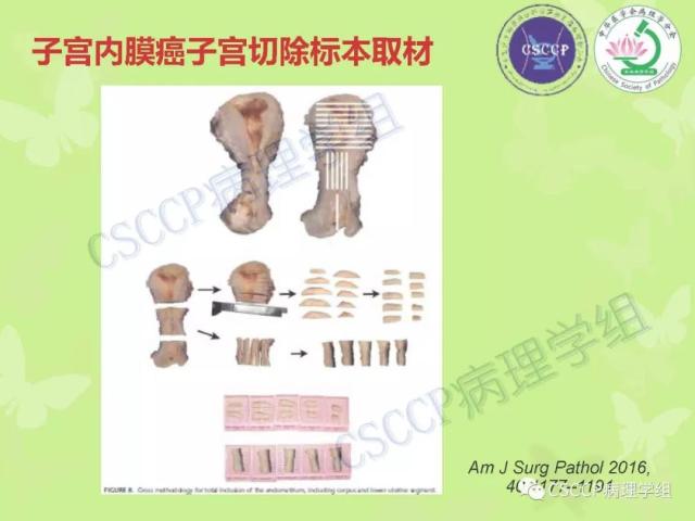 宫颈与子宫病变病理标本取材