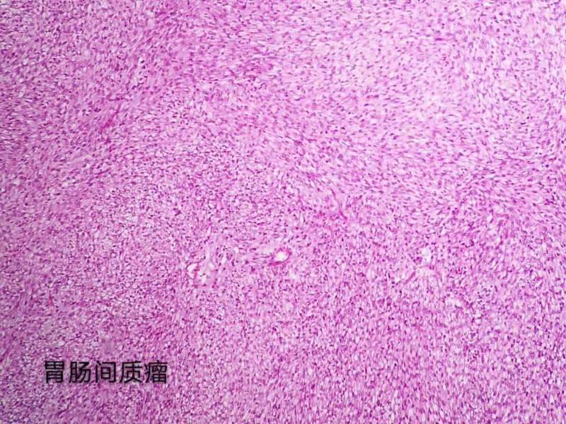 病理科工作札记（三十四）巨大胃肠间质瘤