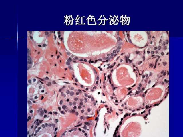 前列腺病理诊断线索（上）——黄教悌