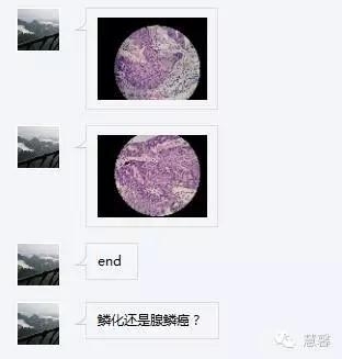 子宫内膜癌、宫内膜增殖症的鳞状分化、桑葚化生等问题（石岩分享，刘从容老师讲解）