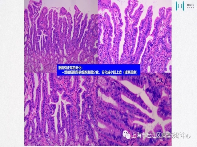 上消化道早癌病理诊断中的困惑及基本对策回顾