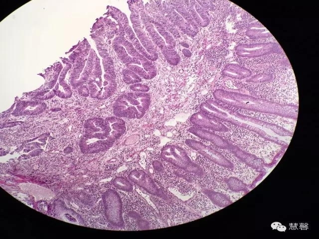 结、直肠管绒毛状腺瘤-高级别病变诊断等相关问题2（悄悄分享、孔祥田(Max)*Roswell*老师讲解）