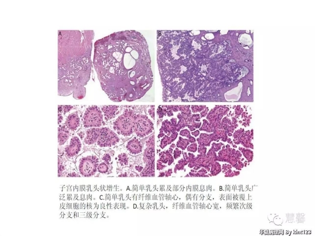 子宫内膜乳头状增生（甜甜分享病例，孔祥田(Max)*Roswell*老师讲解，kent翻译整理文献）