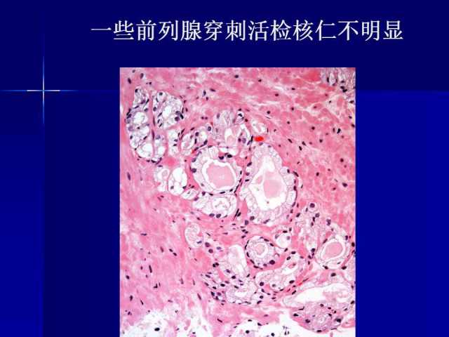 前列腺病理诊断线索（上）——黄教悌