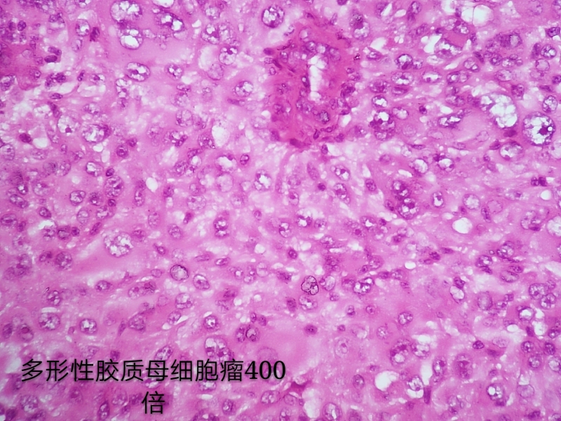 病理科工作札记（三十八）胶质母细胞瘤