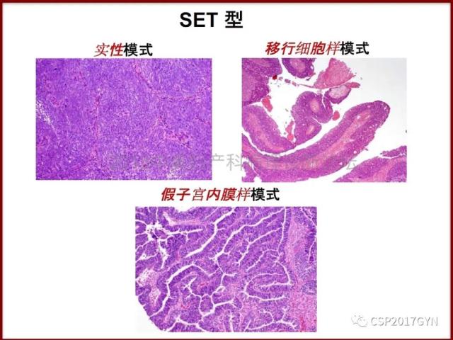 非粘液性卵巢肿瘤的诊断挑战