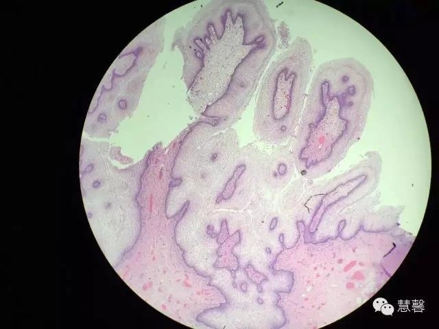 阴道鳞状上皮乳头状瘤？尖锐湿疣？（孔祥田老师病例分享，粉蓝医疗科技（杭州）有限公司女性生殖2群讨论，孔祥田(Max)*Roswell*老师讲解）