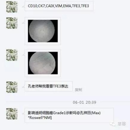 透明细胞乳头状肾细胞癌？TFE3 Traslocation Carcinoma？（赵洋分享，孔祥田(Max)*NM老师讲解）