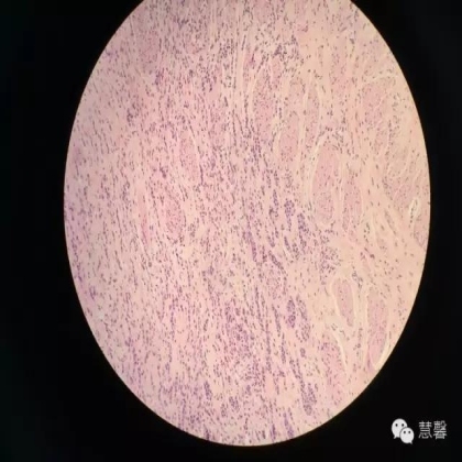 High grade nested variant Urothelial carcinoma(老胡分享，孔祥田老师讲解)