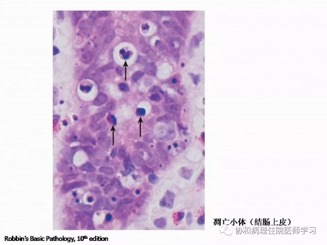 病理学基础知识 : 核分裂像的识别