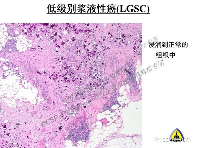 中华病理学会基层培训遵义站讲座（一）——卵巢和输卵管浆液性肿瘤的诊断和鉴别诊断