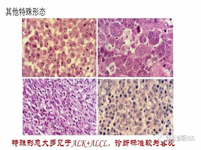 间变大细胞淋巴瘤