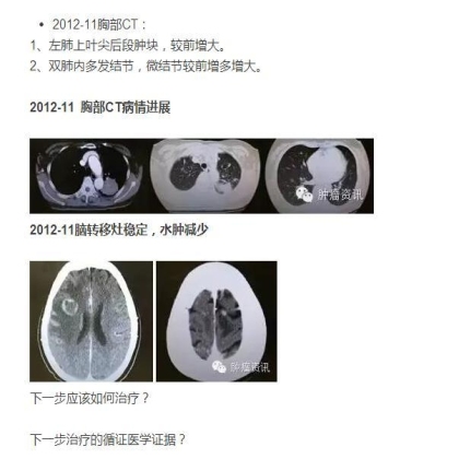 中日韩个体化诊疗案例大赛经典赏析之三——鳞癌诊断需警惕，二次活检为肺腺癌，EGFR 21exon突变，二线TKIPFS28月