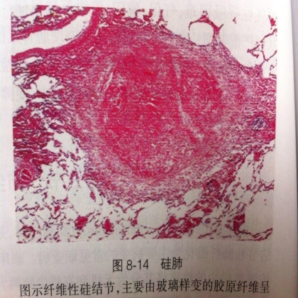 硅结节和新月体形成的病理变化