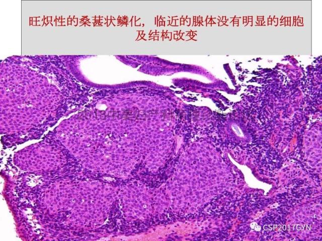 子宫内膜假肿瘤性病变及类似癌样病变