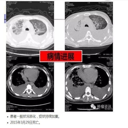 中日韩个体化诊疗案例大赛经典赏析之十——驱动基因双突变，两种靶向药物均无效，个体化治疗的阿克琉斯之踵