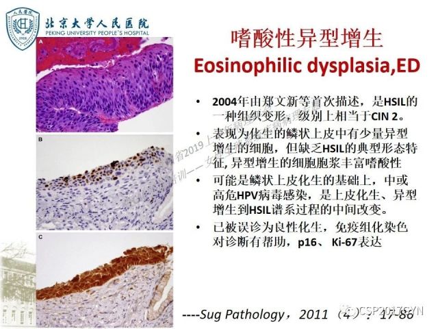 中华病理学会基层培训遵义站讲座（三）——宫颈鳞状上皮病变的病理诊断与鉴别诊断