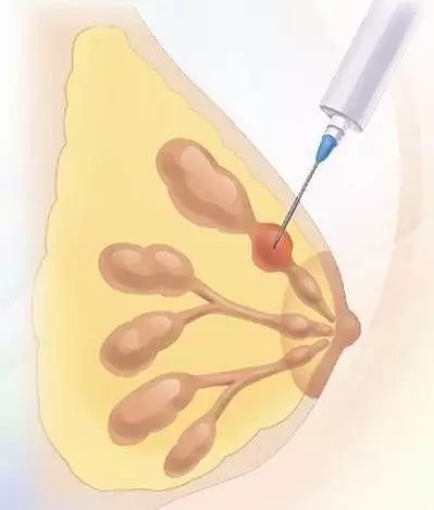 科普 | 乳腺癌的病理活检
