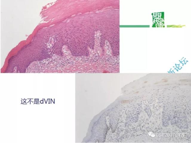 非HPV相关的外阴鳞状细胞肿瘤