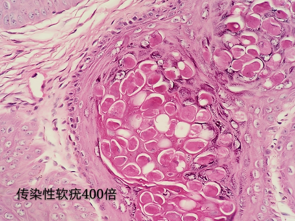 病理科工作札记（三十七）传染性软疣
