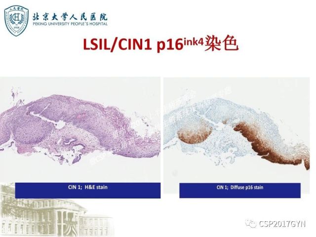 中华病理学会基层培训遵义站讲座（三）——宫颈鳞状上皮病变的病理诊断与鉴别诊断
