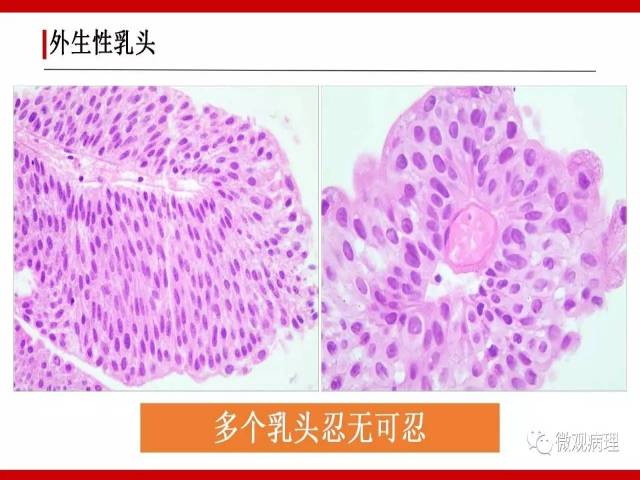 泌尿课程/非浸润性尿路上皮病变诊断的一些困惑