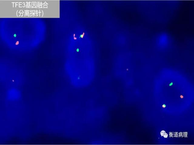 一例罕见分型肾脏肿瘤的病理解析