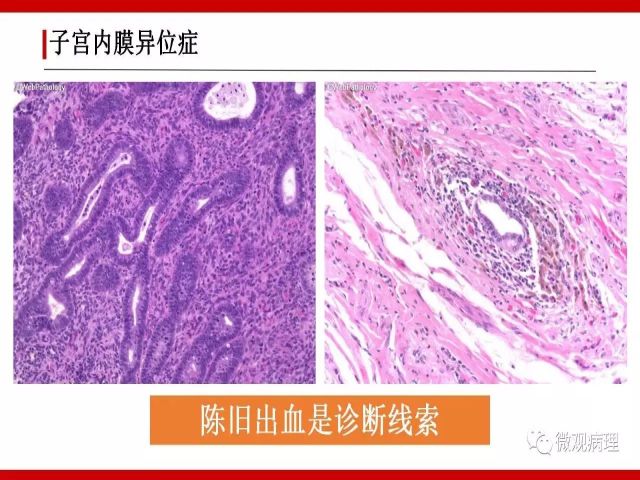 泌尿课程/尿路腺样病变的诊断要点