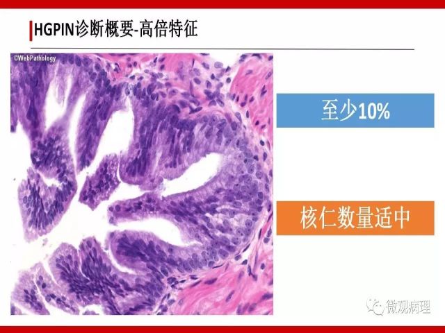 泌尿课程/一个中心,两个基本点:HGPIN诊断概要 泌尿课程/一个中心,两个基本点:HGPIN诊断概要