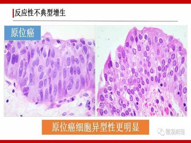泌尿课程/非浸润性尿路上皮病变诊断的一些困惑