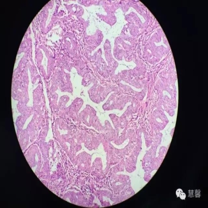 高分化子宫内膜样癌与分泌期子宫内膜、黏液腺癌的鉴别（孔令英分享，刘从容老师讲解）