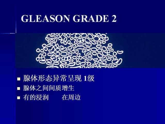 前列腺病理诊断线索（下）——黄教悌