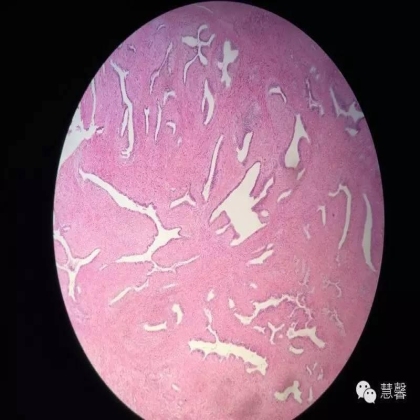子宫腺肉瘤【吴梅娟】分享；【刘从容】老师讲解）