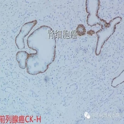 免疫组化结果的分析和常见问题的处理